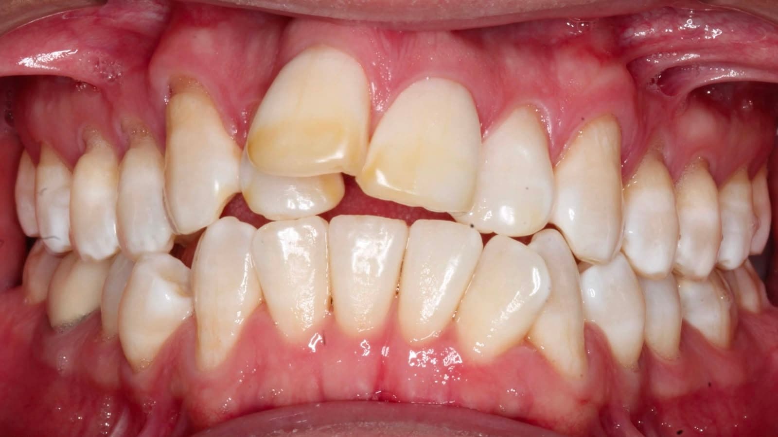 Dientes antes del tratamiento dental