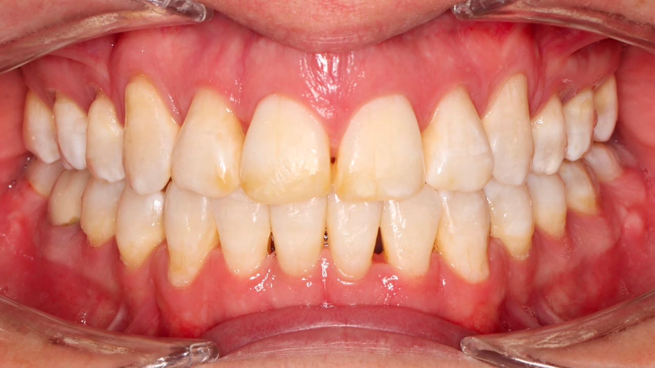 Dientes después del tratamiento dental